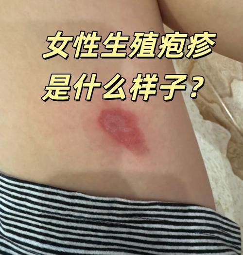 hsv-2型疱疹病毒能治愈吗图标
