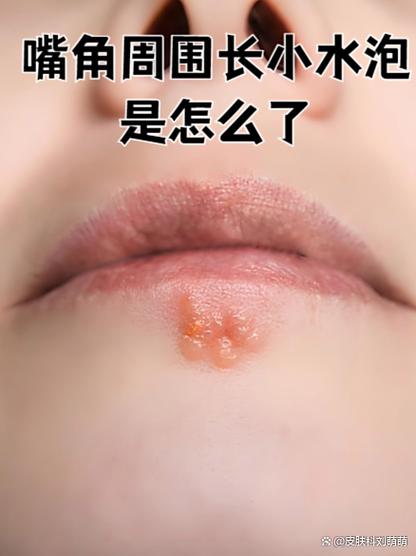 如何快速消除嘴角的火炮图标